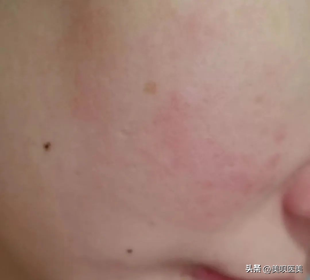 敏感肌换季大救星来了,换季敏感肌的正确使用方法