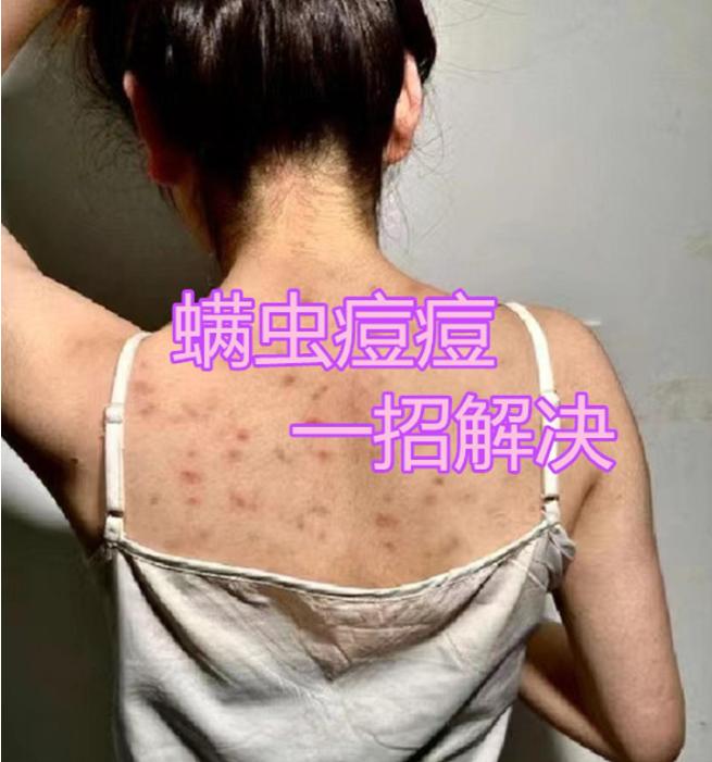 后背长了好多痘用什么喷雾,后背大粉刺脓包破了怎么处理