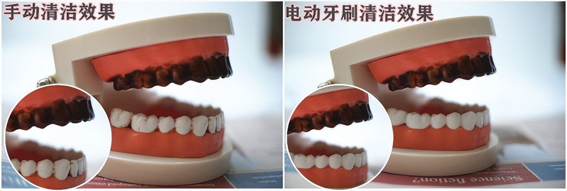 电动牙刷不伤牙和不伤牙的区别,电动牙刷和传统牙刷哪个伤牙