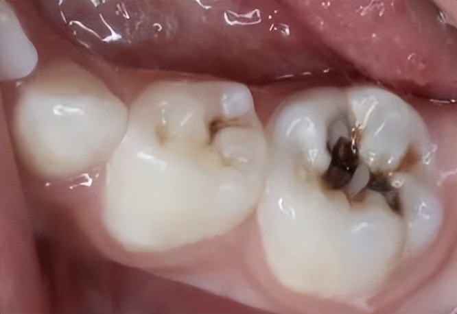 早期龋齿和中期龋齿的区别,科普口腔龋齿图片