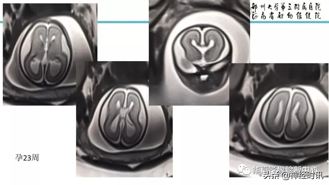 透明隔腔影像诊断,25张ppt