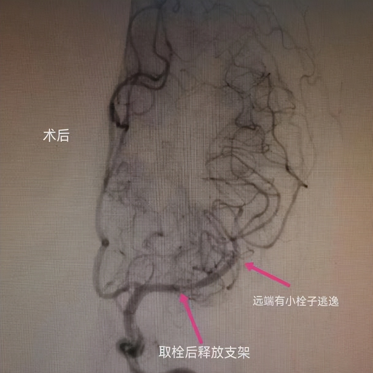沣东院区脑病病区成功完成多例脑血管造影及颅内支架植入术