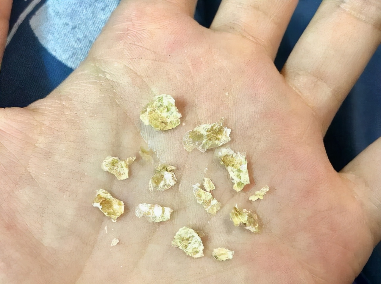 为什么有的人耳屎是湿黄的,为啥有人的耳屎是湿的