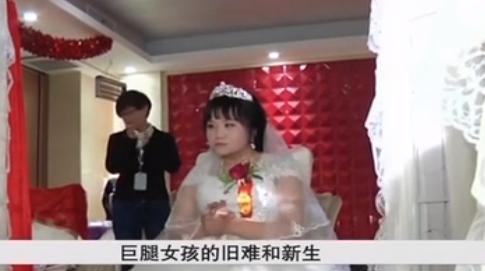 小腿巨粗的女孩,河南女子患病腿粗如大象