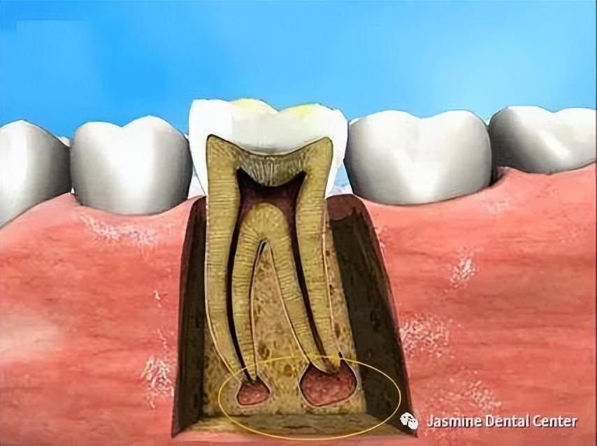 牙齿松动怎么办教你一招恢复,牙齿咬到硬东西松动了怎么办