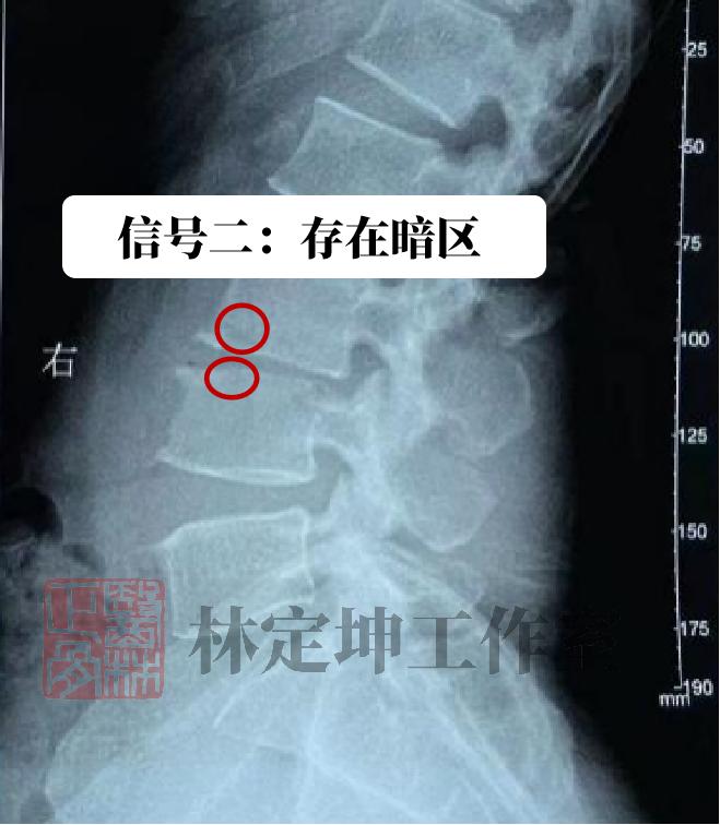 腰痛针灸和贴膏药哪个效果好,腰腿痛针灸最有效吗