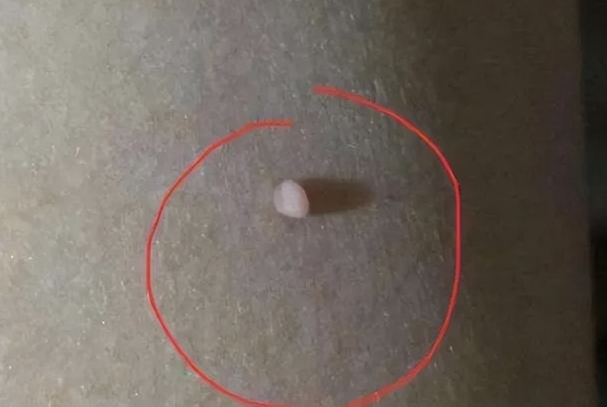 脖子和腋下的小肉粒可以揪掉吗,脖子上的小肉粒用手扯掉吗