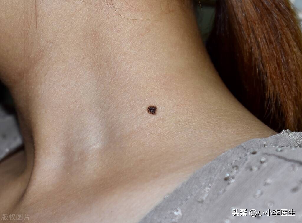 激光祛痣笔真的有用吗,冷冻祛痣好还是激光好