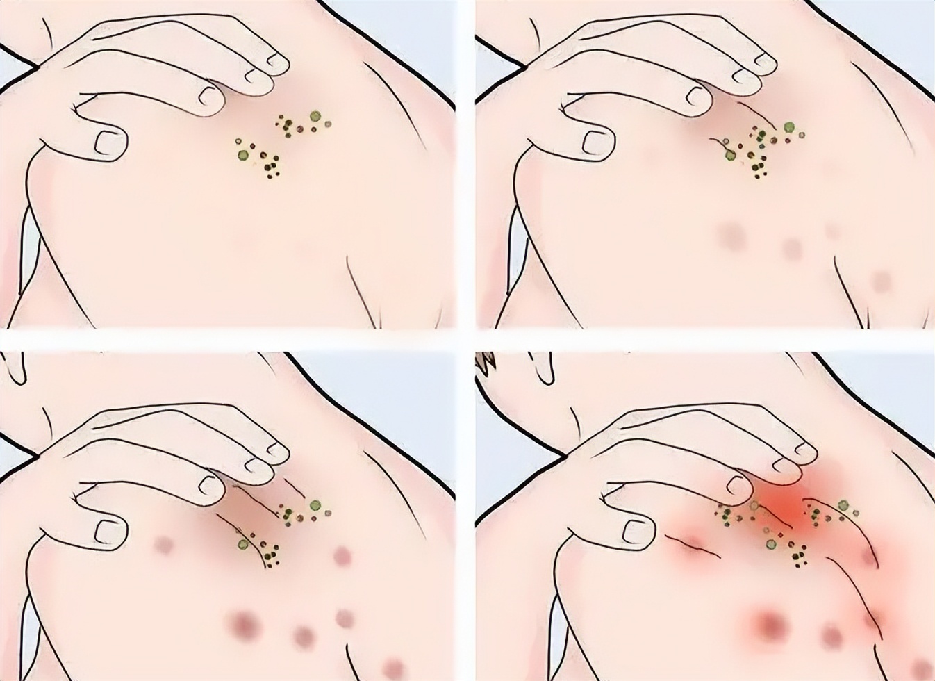 激光去除疤痕能改善到什么程度,激光祛除疤痕能改善到什么程度