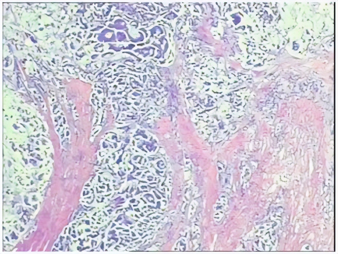 中国国内结直肠癌最新治疗,结直肠癌治好的可能性大吗