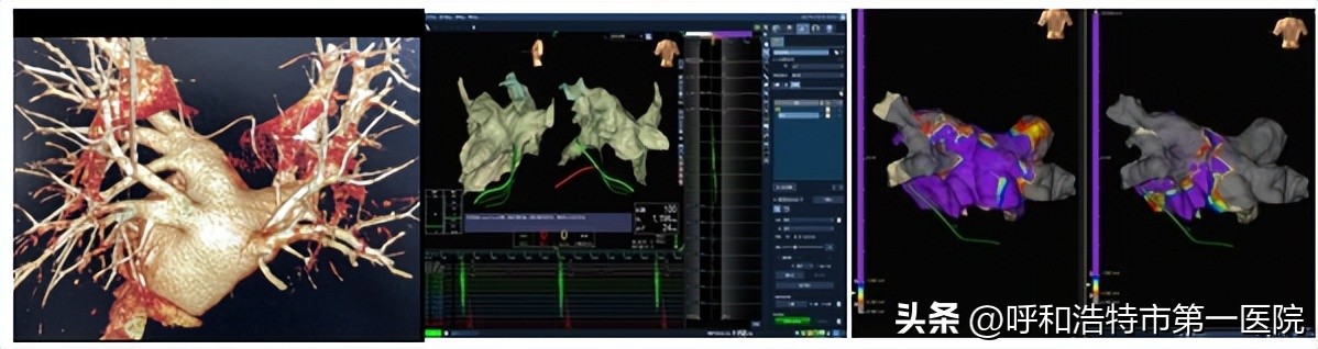 我院心内科成功完成房颤冷冻球囊导管消融术赋能医院高质量发展