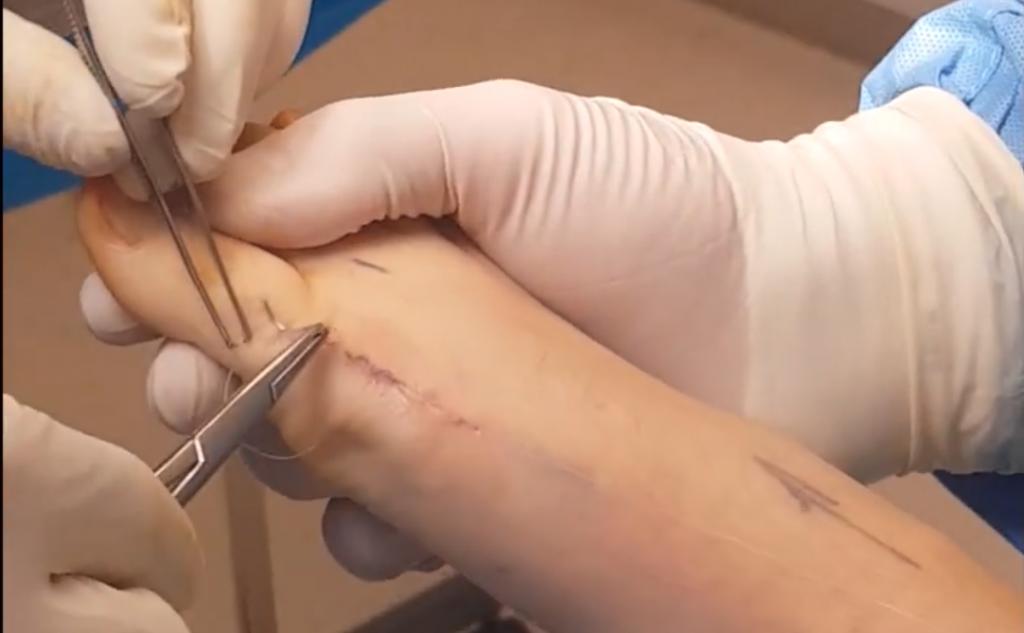 拇外翻疼痛是什么原因,如何治疗拇外翻疼痛的方法图解