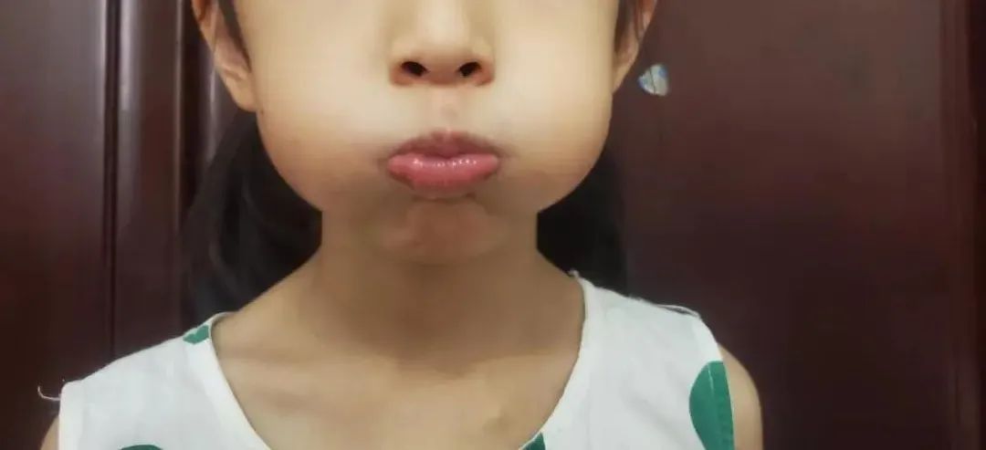 孩子嘴巴张不开发音小,小孩声带发育异常导致说话不清楚