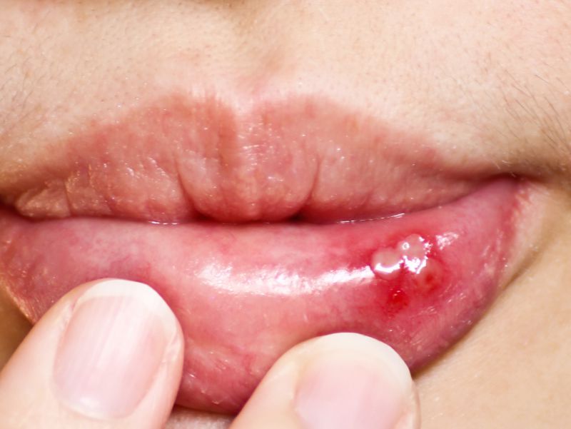 口舌生疮牙龈肿痛偏方,口舌生疮牙龈肿痛吃什么药好得快