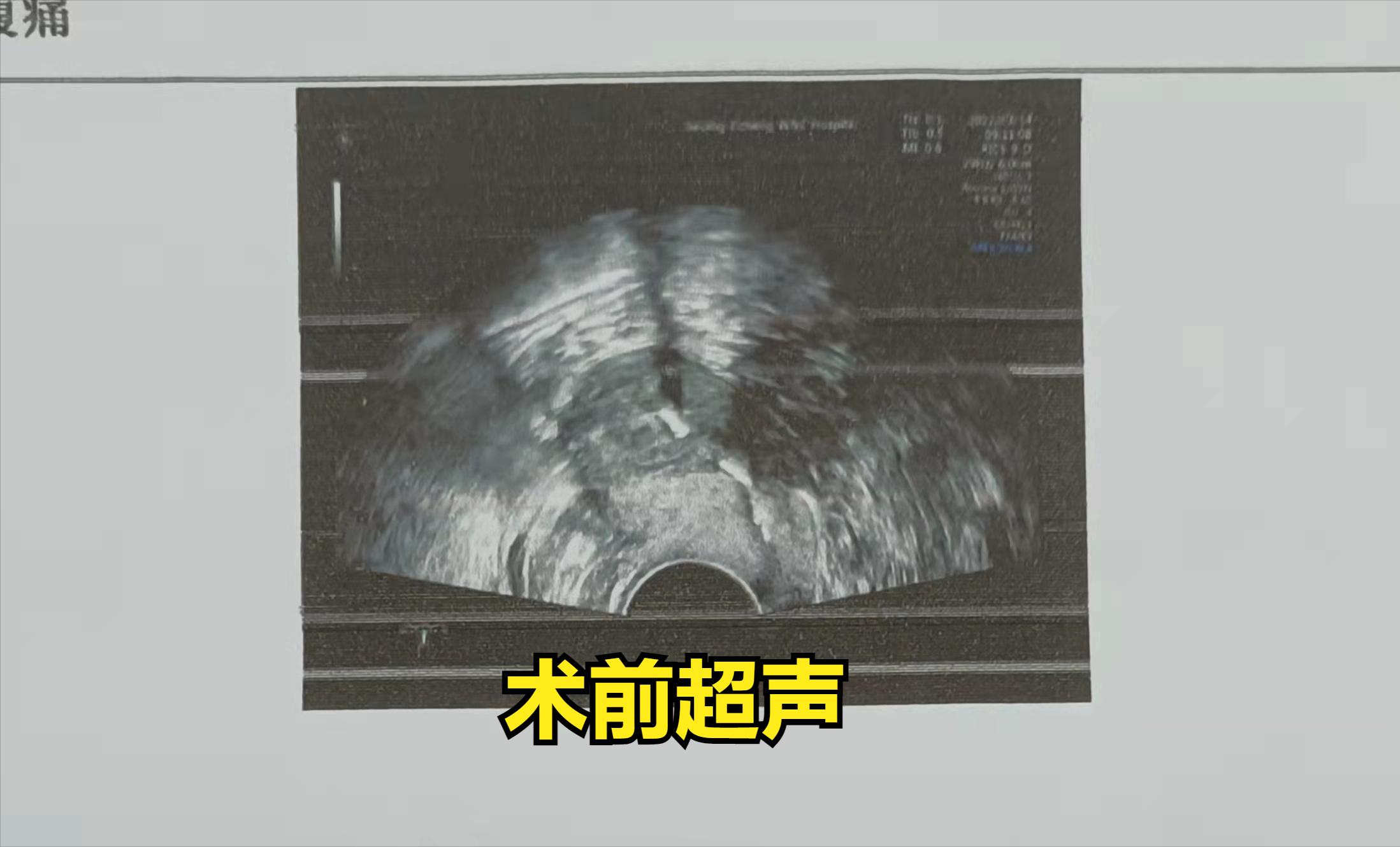 有没有最快的取环方法,取环大多数要几分钟啊