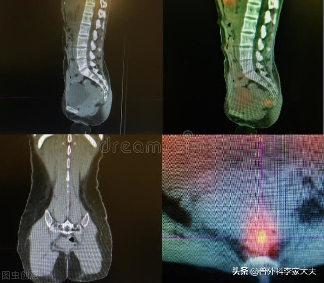 直肠癌术后复发还有得治疗吗,直肠癌新辅助疗法加手术复发率