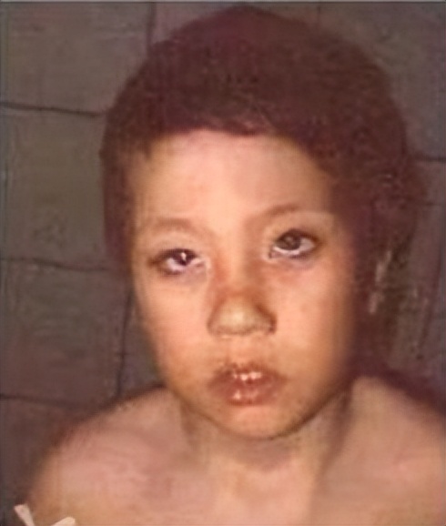 关注罕见病的视频,歌舞伎综合征是什么意思