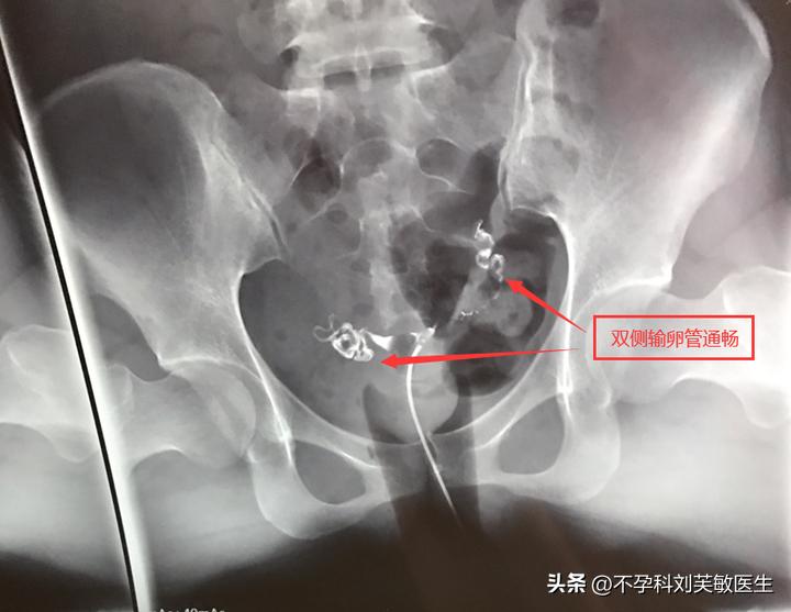 输卵管造影怎么看片子图解,最新的输卵管造影方法