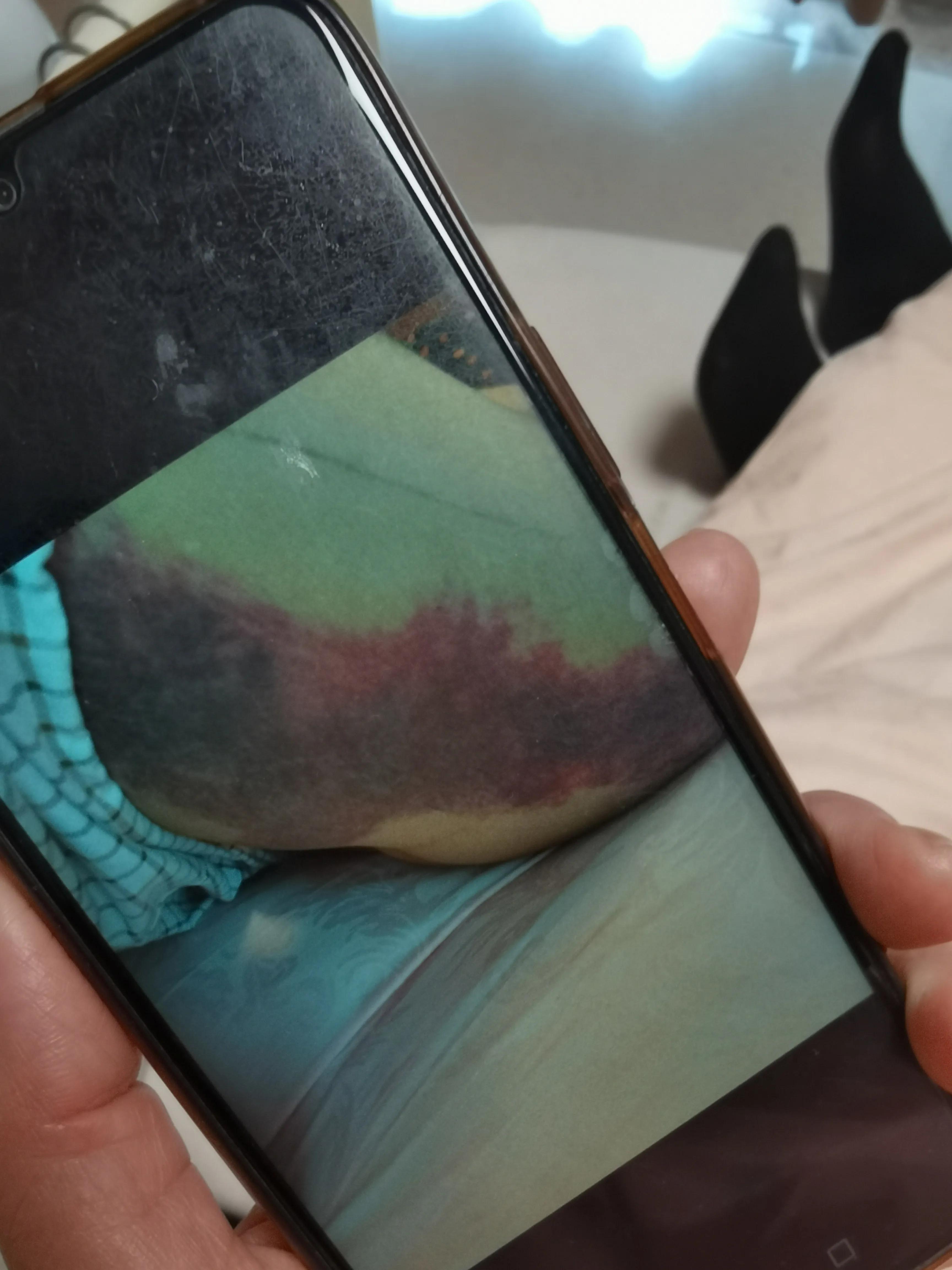 做了艾灸之后有点出血,做了艾灸后少量出血