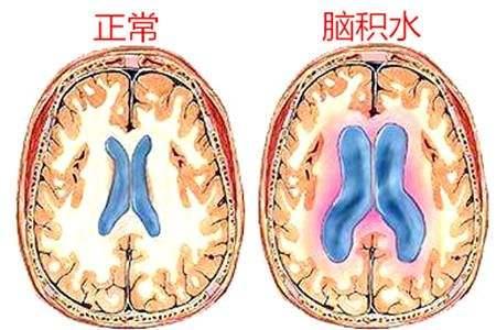 脑积水常见问题,脑积水不动手术能治好吗