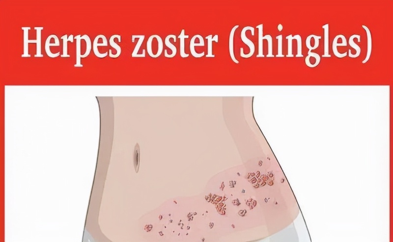 老年人带状疱疹的症状和治疗方法,带状疱疹发病前1-3天首先出现症状