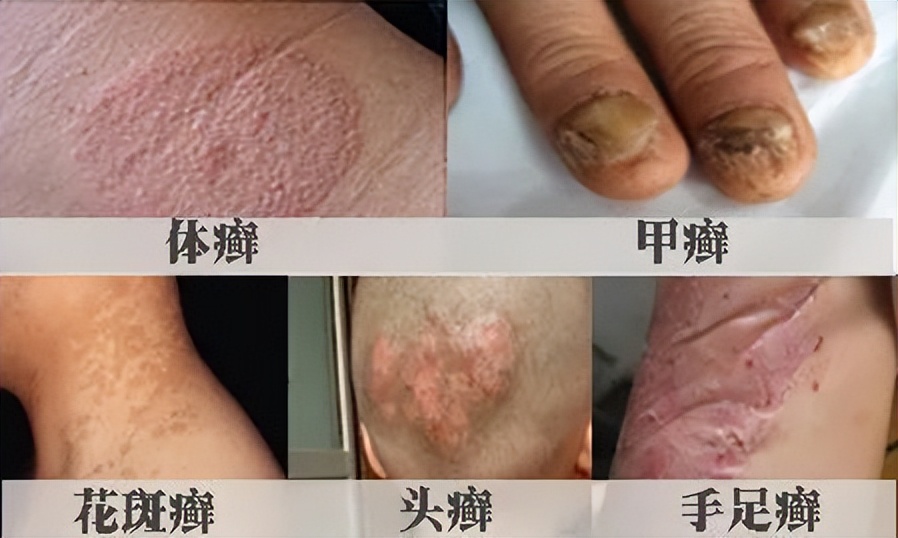 生活中最常见的4种皮肤病,皮肤科可以看多种皮肤病吗