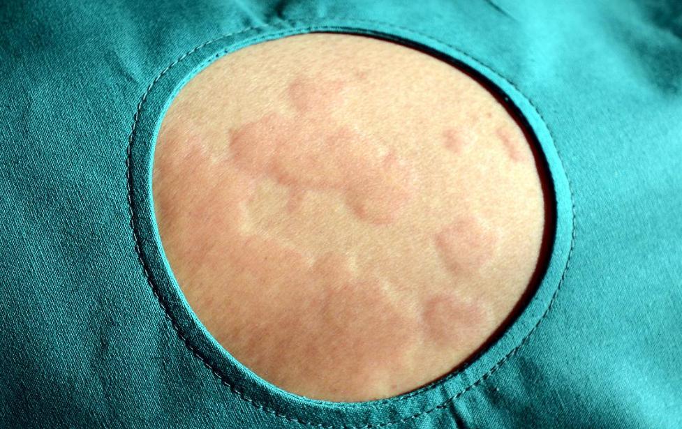 一些奇怪的过敏原,那些千奇百怪的过敏源