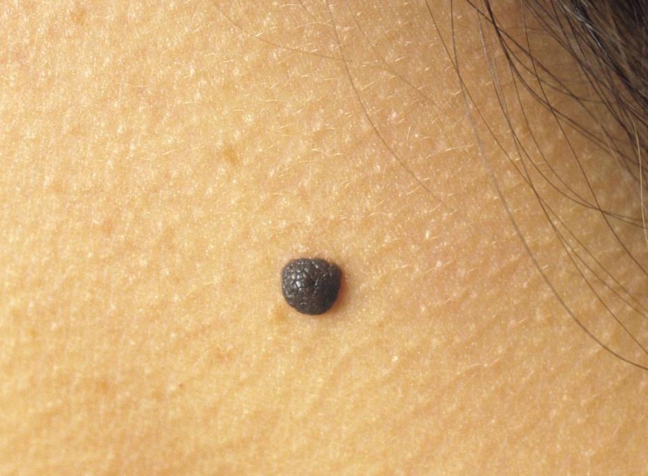一旦皮肤上长了这5种痣,十有八九是黑色素瘤,一拖再拖会很麻烦