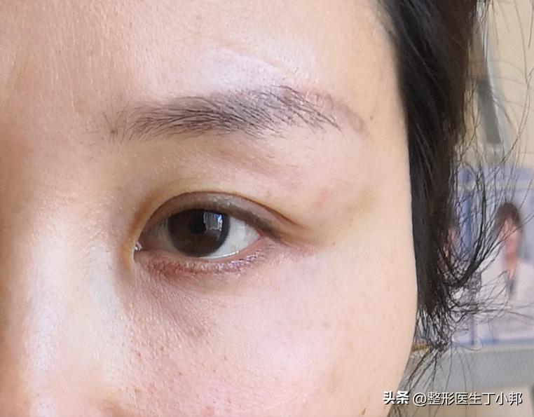 眼尾下垂眼综合可以调整吗,大小眼眼皮松弛怎么改善