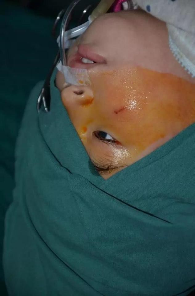 孩子眼球20分钟被熔化,小孩眼珠被熔化了怎么办