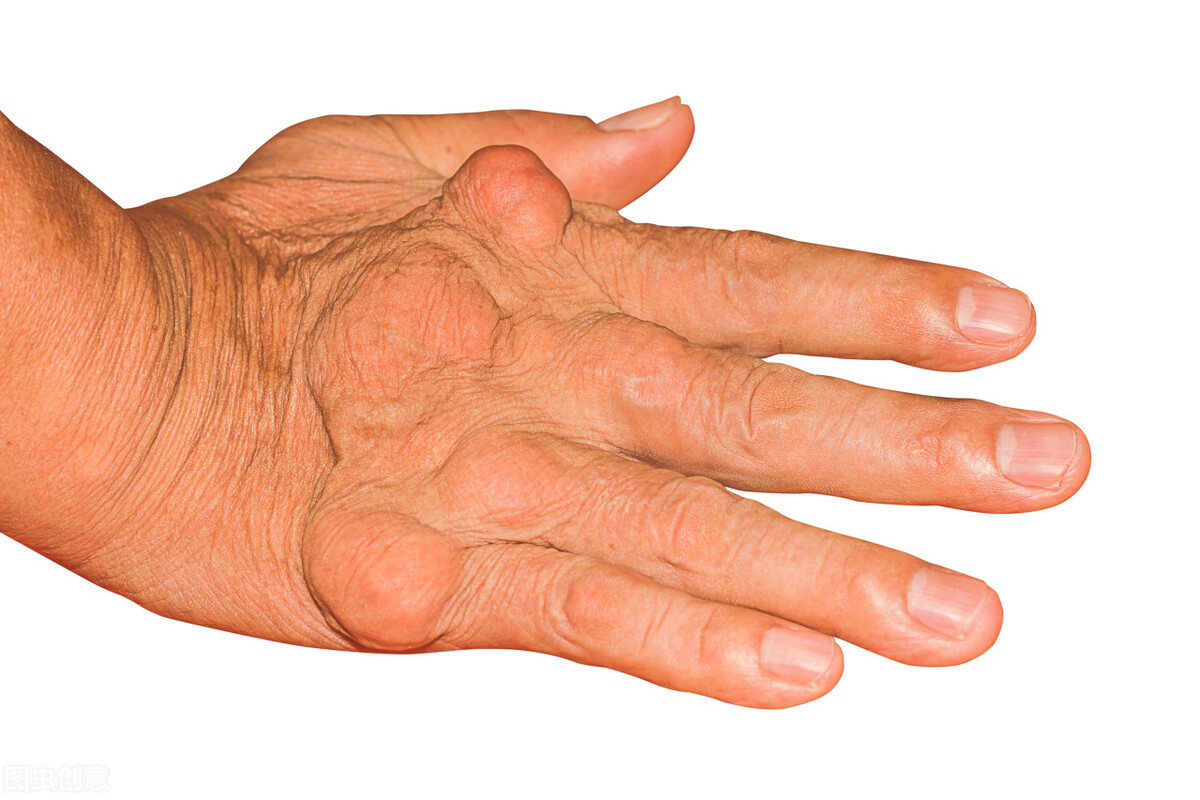 痛风吃非布司他一周尿酸降到400,快速解决痛风药非布司他怎么吃