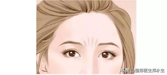 激光祛面部皱纹能保持多久,面部皱纹去除拉皮可以保持多久