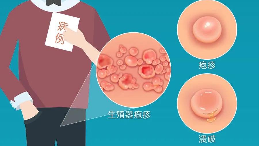 为什么越来越多男人选择嫖娼？一次嫖娼会带来多少性病？都看看吧