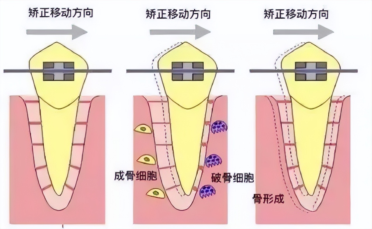 矫正失败还能二次矫正吗,二次矫正牙齿后遗症