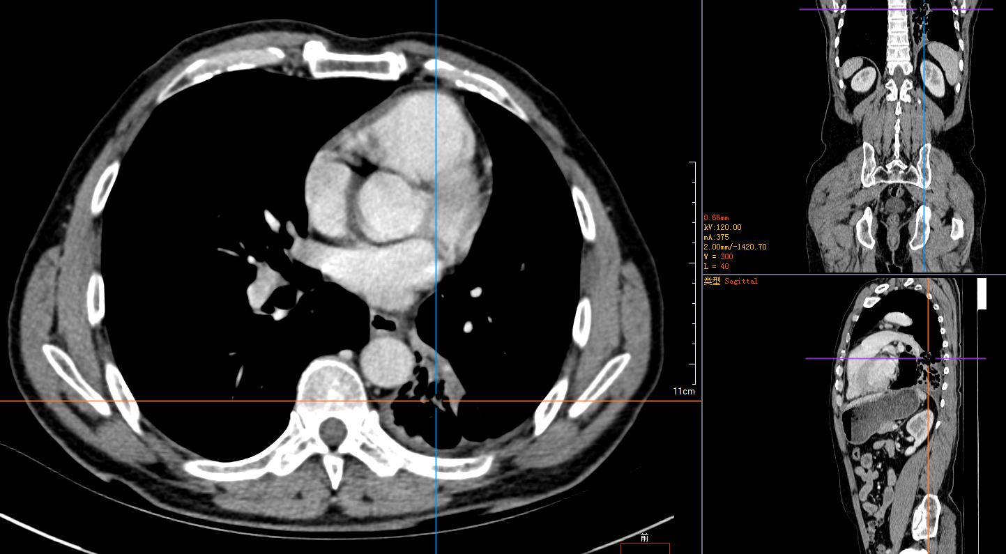 免疫治疗6次后肿瘤消失了,肺鳞癌中晚期化疗联合免疫治疗