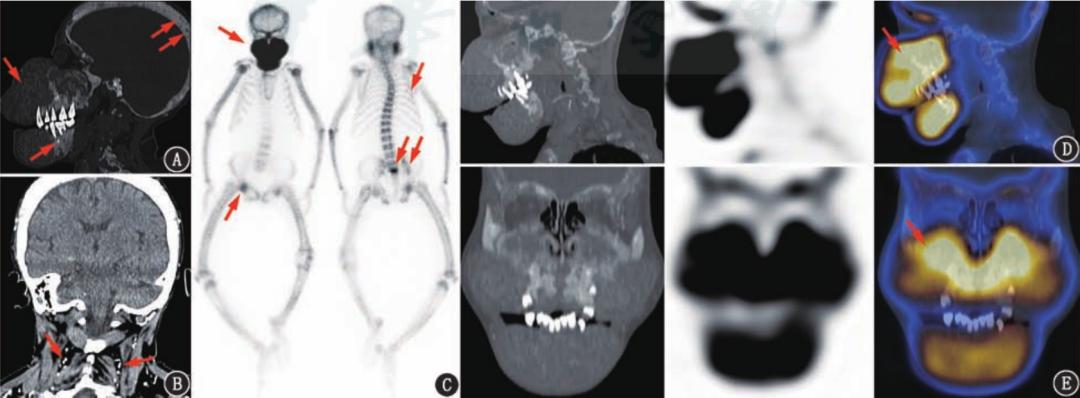 别的指标正常就是肌酐高怎么回事,这项指标升高需警惕前列腺癌