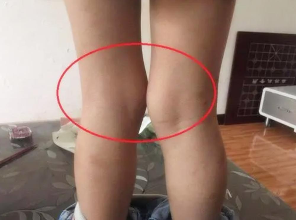 o型腿正确抱娃方法,怎么抱小孩腿不会变形