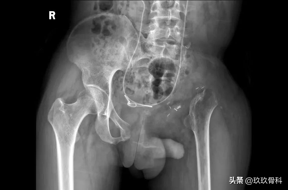 力达康定制型模块化假体治疗“肿瘤切除术后半骨盆缺损”