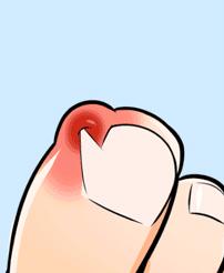 一走路脚指甲里疼怎么回事,一走路脚趾骨疼痛是什么原因呢