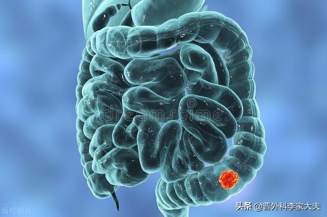 直肠癌腹膜转移一般生存期,结直肠癌腹膜转移治愈的案例