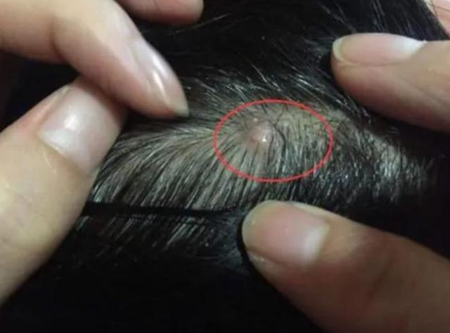 头皮上总是长疙瘩和脓包如何根治,头皮上长疙瘩脓包怎么回事
