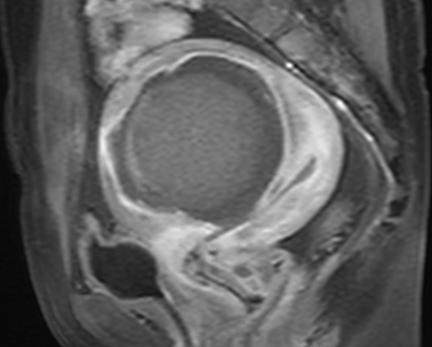 子宫肌瘤海扶刀301医院,子宫肌瘤海扶刀治疗后再次手术