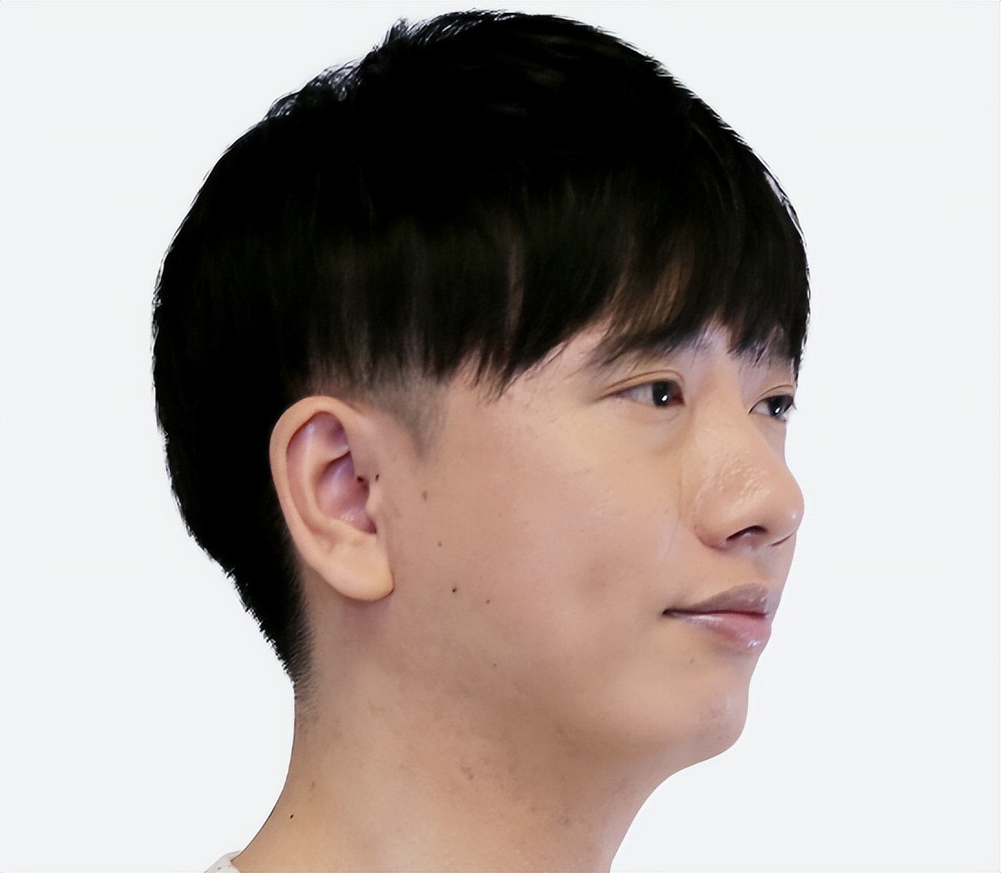 痘印痘坑做微针有效果吗,小伙子痘坑修复亲身经历