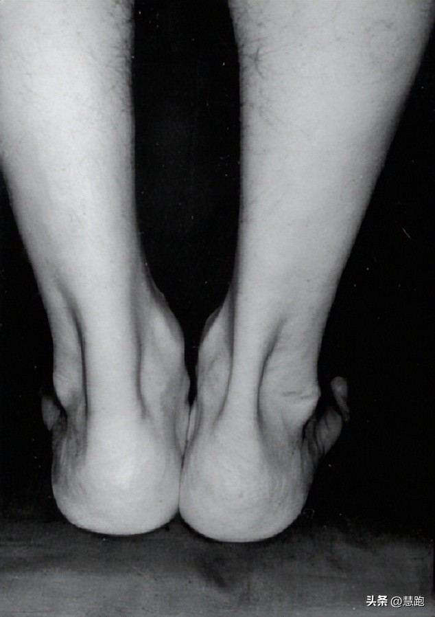 这类顽固性的跑步伤痛最让跑者头疼：4种有效康复方法教你破解