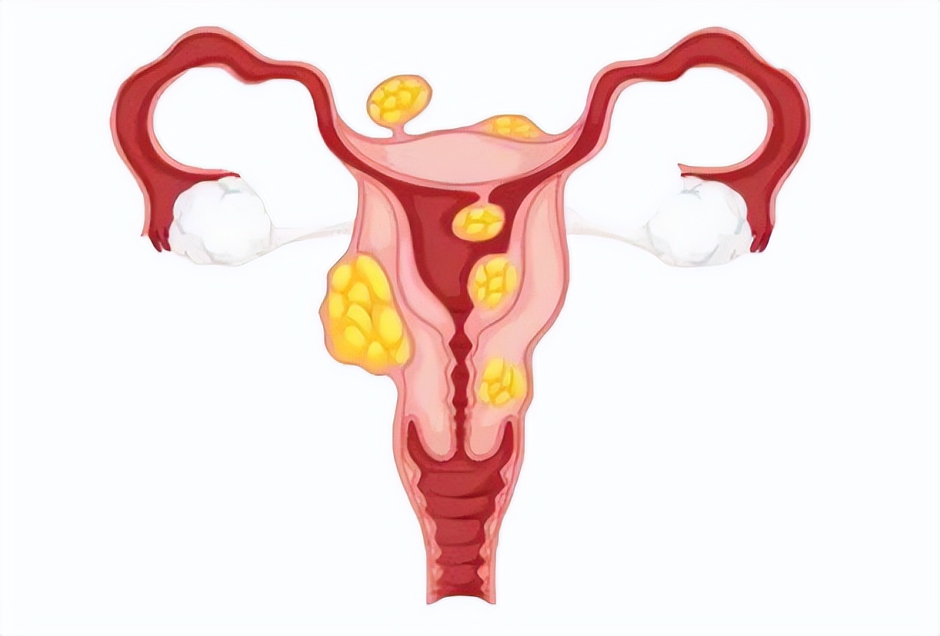 子宫肌瘤什么情况下要切除,子宫肌瘤可以反复切除吗