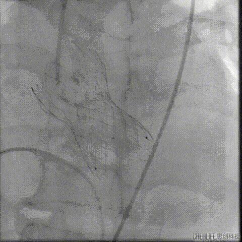病例回顾与分享,腹膜后血肿介入治疗