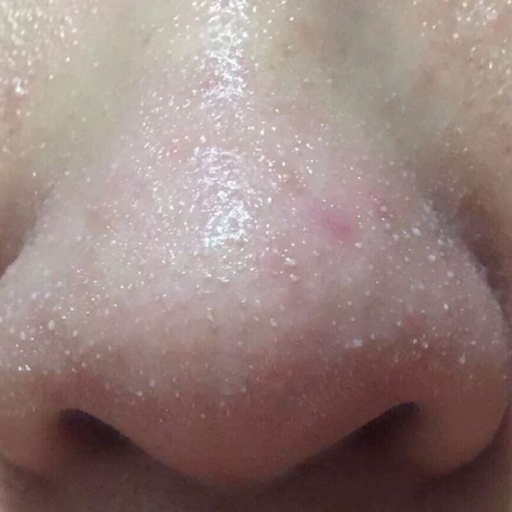 超微小气泡美容有用吗,美容院小气泡