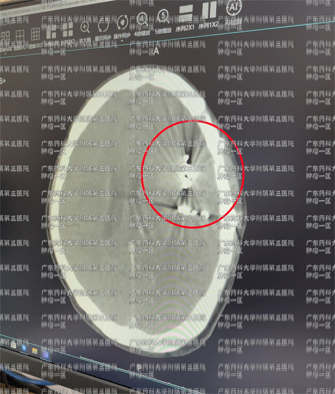 脑瘤复发了,脑瘤后期病人怎么康复