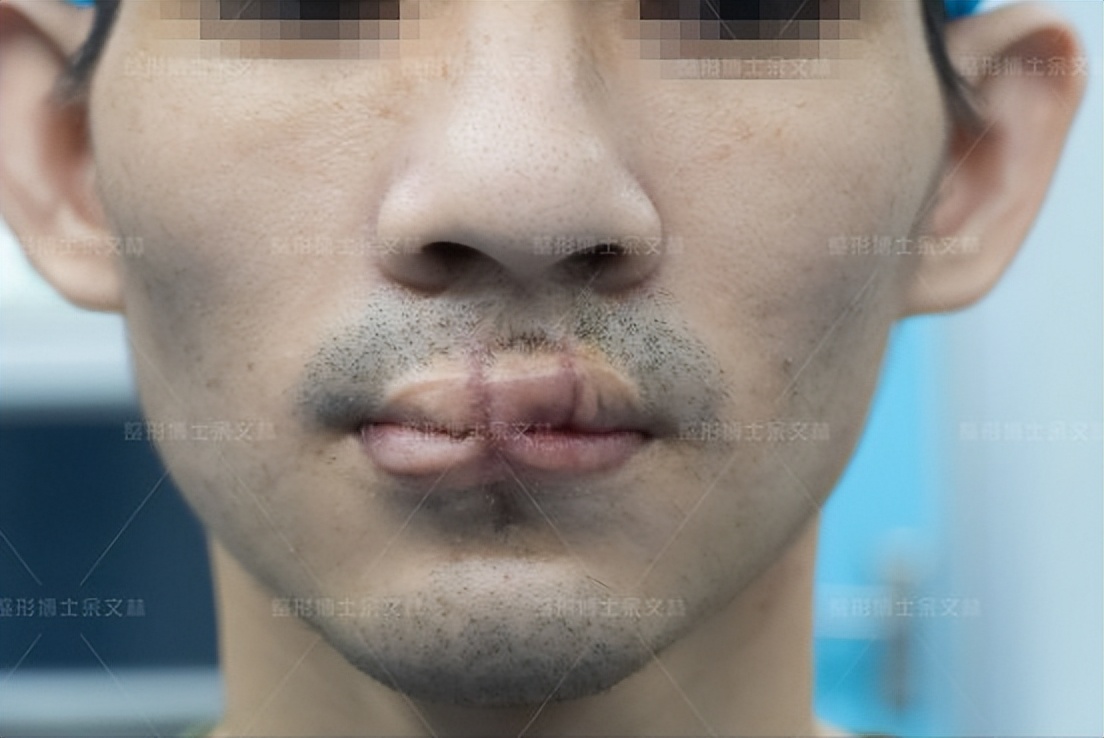 嘴巴缺了一小块肉多久能好,嘴巴好像缺了一块肉怎么回事