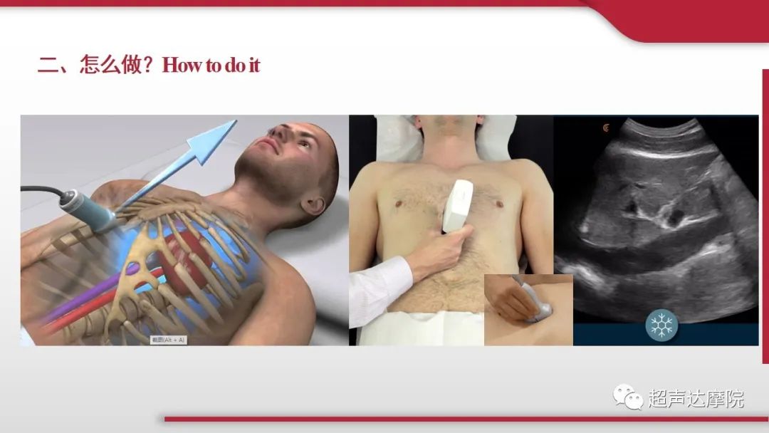 超声下腔静脉评估血容量,超声评估下腔静脉容量图片